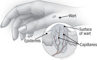 Wart structure on the hand