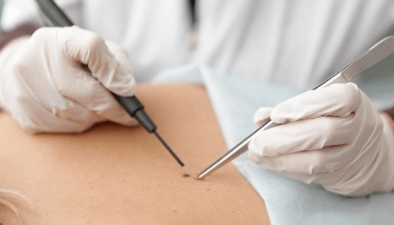 Characteristics of papilloma removal