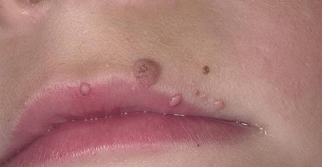 Papilloma on the lips
