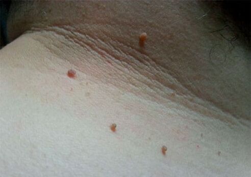 Papilloma on the neck