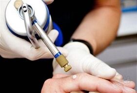 How to remove skin papillomas