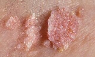 Human Papilloma Virus Photos