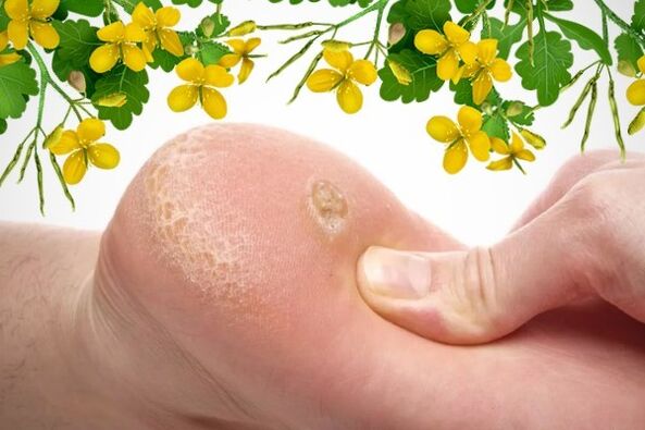 How to treat warts