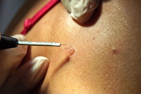 Remove warts from body