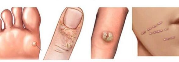 Types of human warts