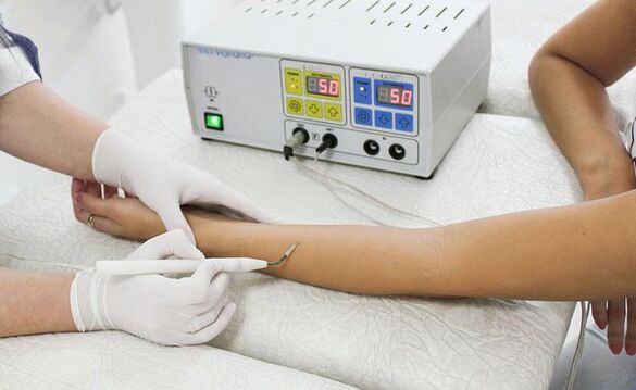 Using radio waves to remove warts