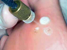 Cryodestruction as a method to remove plantar warts