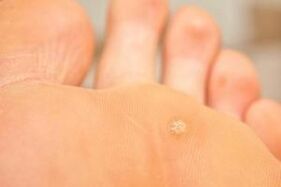 Why do plantar warts appear
