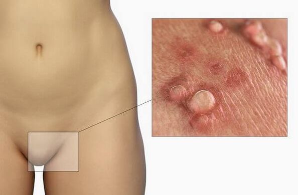 Papilloma in the female groin